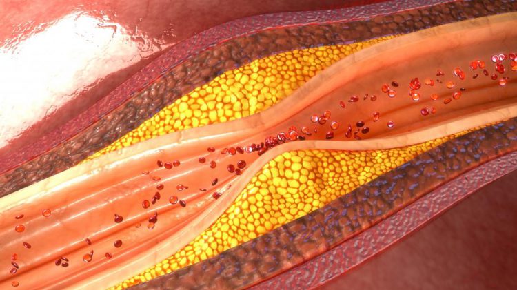 plaque-build-up-inside-of-arteries
